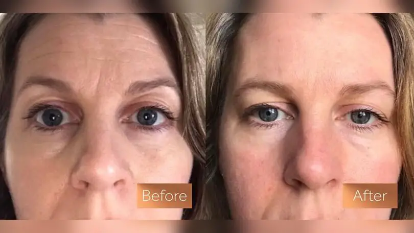 Does Collagen Supplements Work