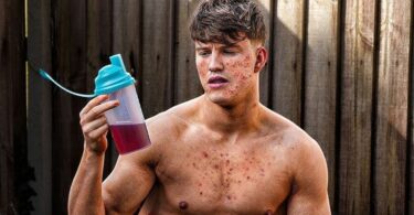 Will Protein Powder Cause Acne